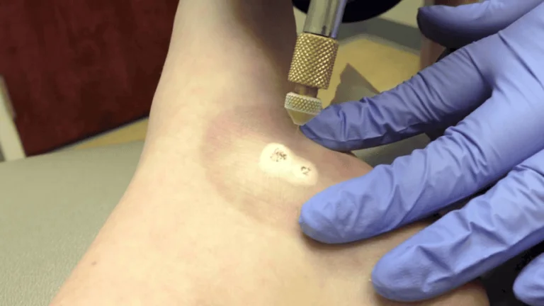 افتادن زگیل بعد از کرایو