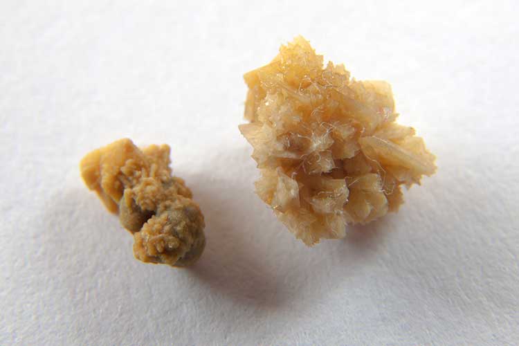 سنگ کلیه