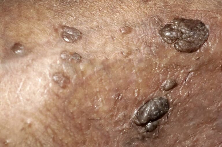 شکل زگیل تناسلی