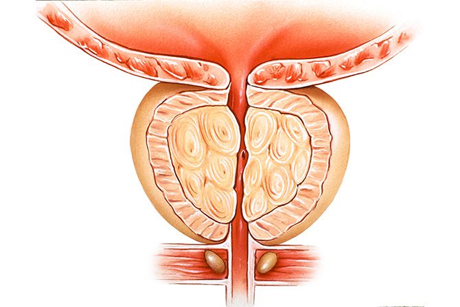 هیپرتروفی پروستات