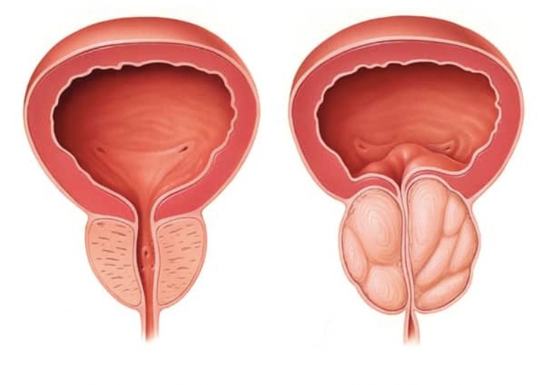 تعریف و مکانیسم وقوع هیپرتروفی پروستات