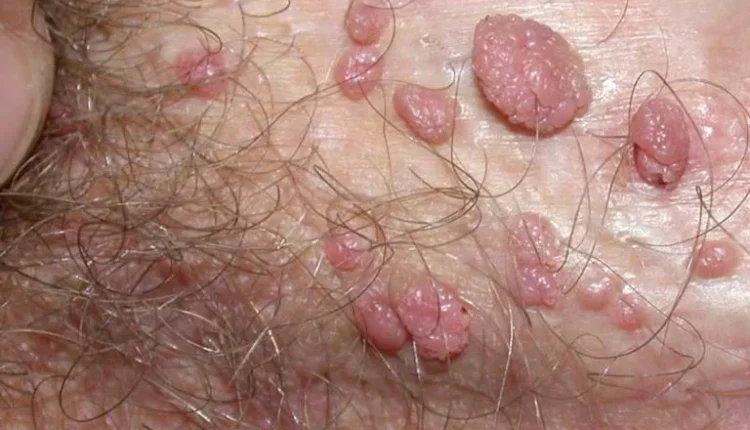 ایجاد زگیل بر روی بدن