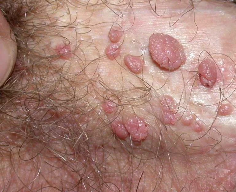 ایجاد زگیل بر روی بدن