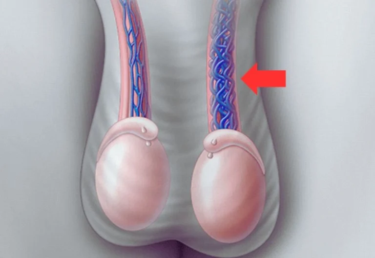 تعریف واریکوسل گرید 2