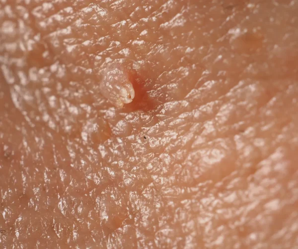 عوامل تشدید کننده واگیردار بودن زگیل تناسلی