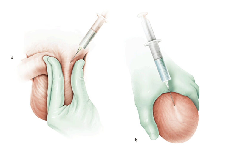 آسپیراسیون