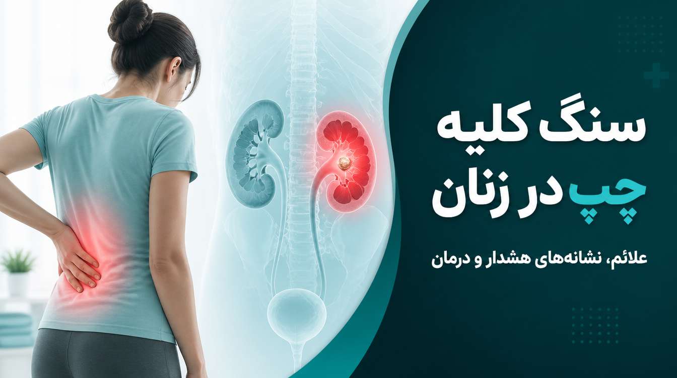 سنگ کلیه چپ در زنان