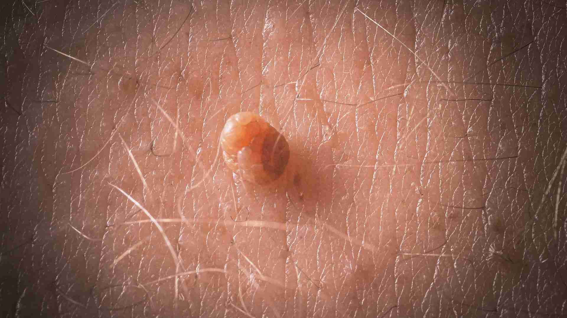 زگیل تناسلی چگونه به وجود میاد