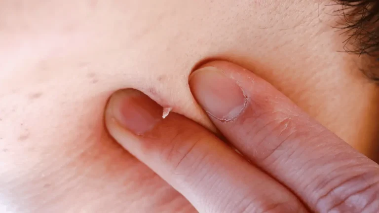 نحوه ورود ویروس اچ پی وی به پوست